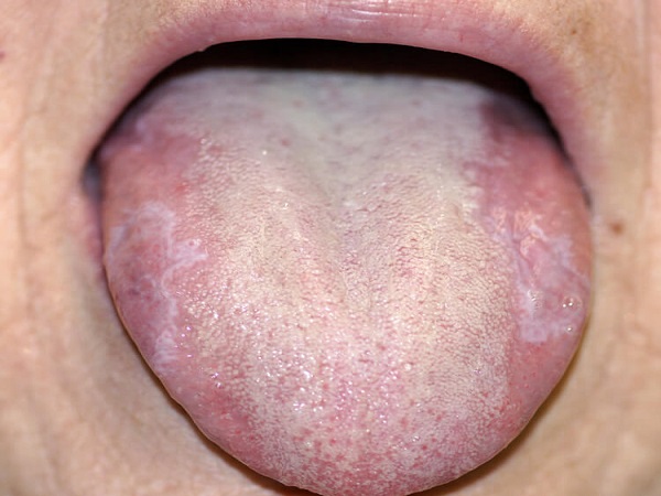 تشخیص بیماری ها از روی زبان