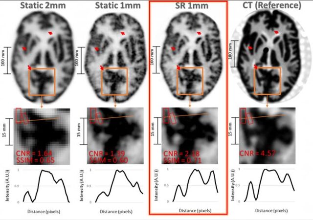 تشخیص آلزایمر با تکنیک جدید در تصویربرداری مغزی – اعصاب و روان